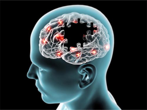 Bệnh Alzheimer là bệnh do sự thoái hóa thần kinh tiến triển, thường gặp ở người cao tuổi
