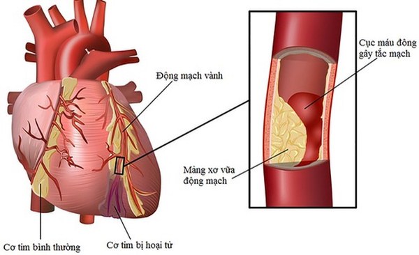 Nguyên nhân sâu xa gây thiếu máu não thoáng qua