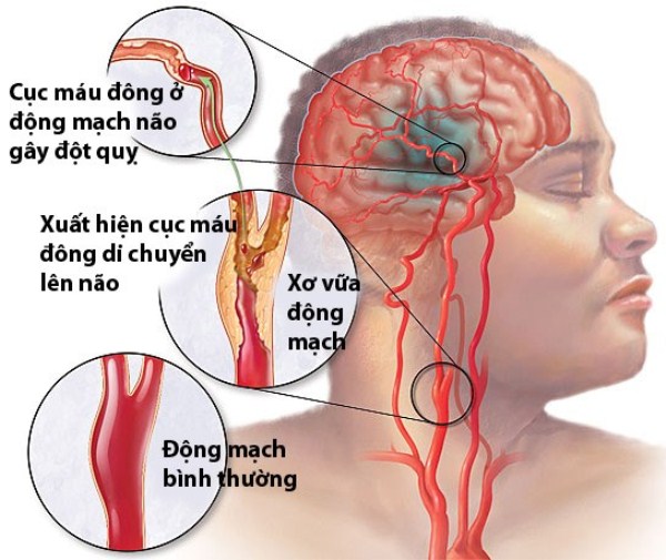 Thiếu máu não cục bộ là gì? Nguyên nhân, triệu chứng, cách điều trị