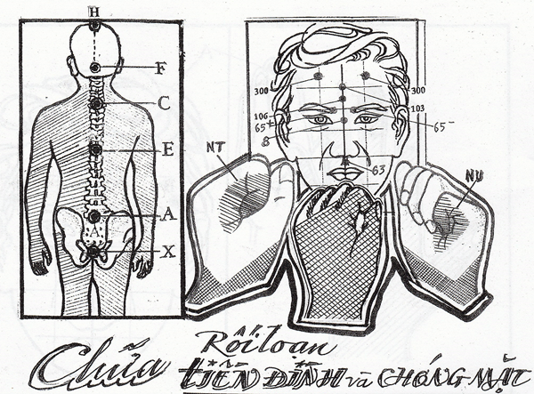 Chữa rối loạn tiền đình bằng diện chẩn