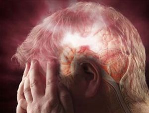 Thiếu máu não là gì? Nguyên nhân, triệu chứng, cách điều trị