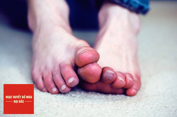 Tổn thương do lạnh có thể gây tấy đỏ và mất cảm giác vùng tiếp xúc