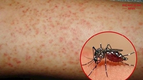 Tổng quan về bệnh sốt xuất huyết