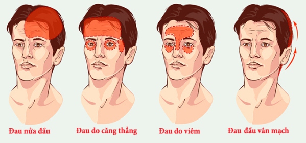 Nguyên nhân đau đầu vận mạch là gì?