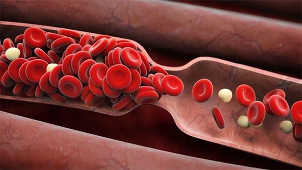 Lưu thông máu kém sẽ khiến nhiều cơ quan trong cơ thể bị thiếu máu