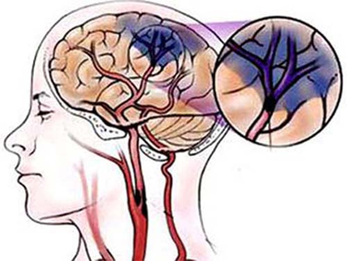 Thiếu máu não là tình trạng lưu lượng máu tới não bị suy giảm