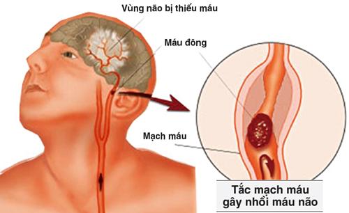 Tắc mạch máu não