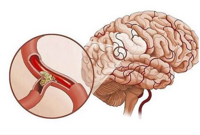 Thiếu máu não gây ảnh hưởng nghiêm trọng đến sức khỏe