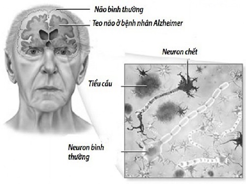Bệnh teo não là gì