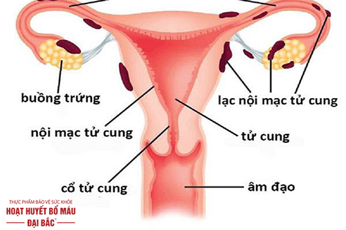 Bệnh lạc nội mạc tử cung nguyên nhân