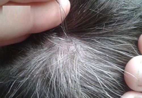 Bị tóc bạc sớm bệnh gì